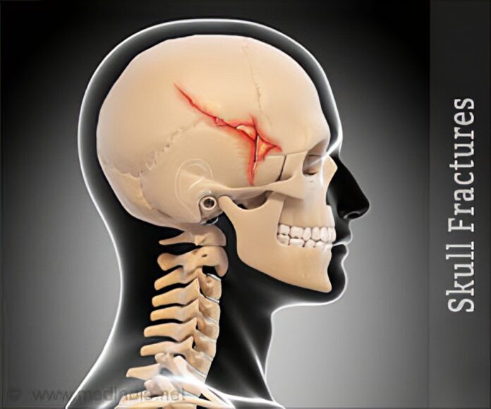 Skull Fracture Exercises for Faster Recovery