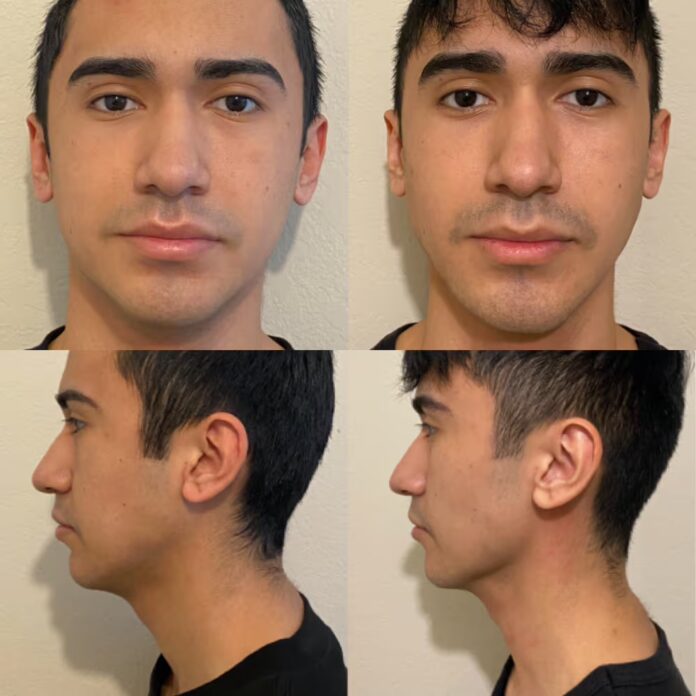 Jaw Exercises Before and After Real Transformation Results