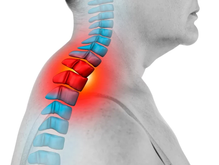 Neck Hump Exercises to Improve Posture Naturally