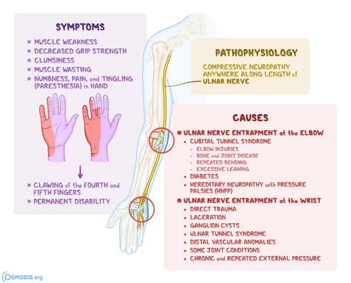Ulnar Nerve Entrapment Exercises to Improve Arm and Hand
